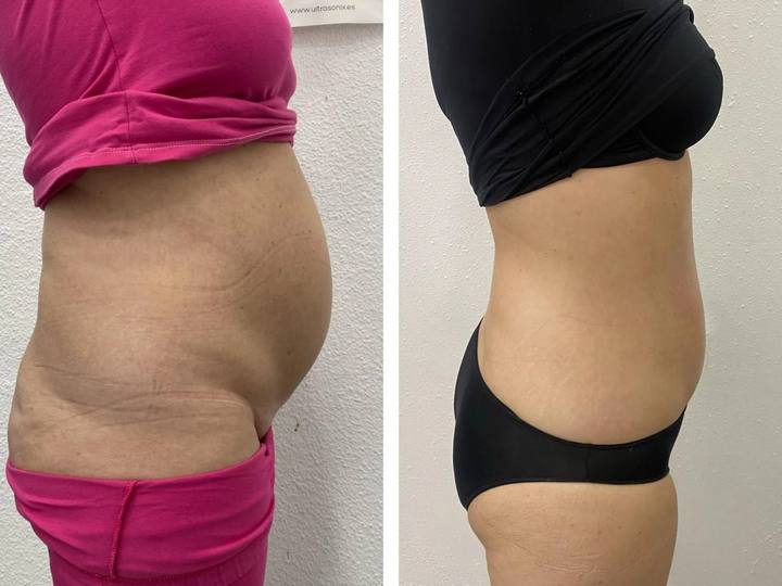Before / After: Less abdominal volume