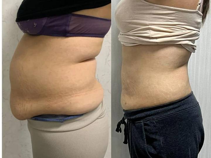 Before / After: Less abdominal fat
